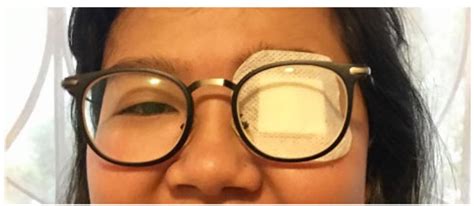 Visual Acuity Improvement in Continuous Divided Occlusion in ...