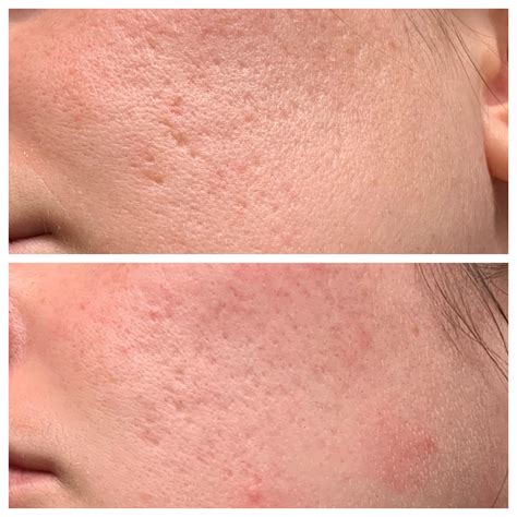 Update! Two months progress on 0.025 for acne scars : tretinoin