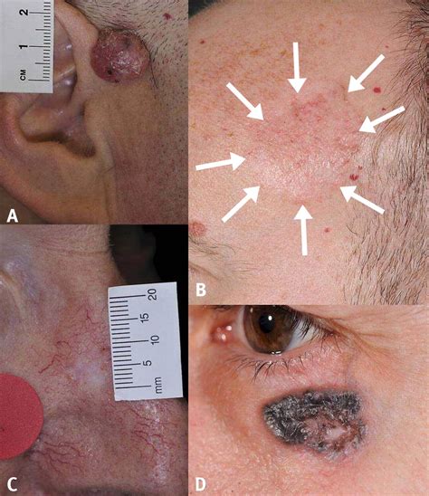 Nodular Type Of Basal Cell Carcinoma According To Some