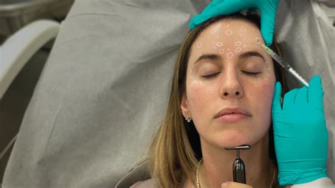 Neurotoxin Treatment - Perfect B