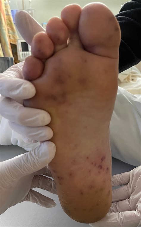 Janeway lesions, Osler nodes, splinter hemorrhages & Roth spots