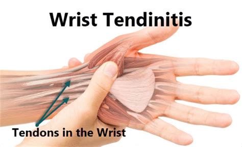 Tendinitis Of The Wrist, 52% OFF | www.pinnaxis.com