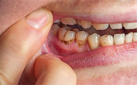 genetics can result in brown spots on teeth - Bradford Family Dentistry
