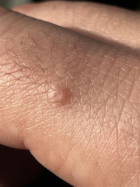 Weird bump on my finger has has gotten larger over the past few months